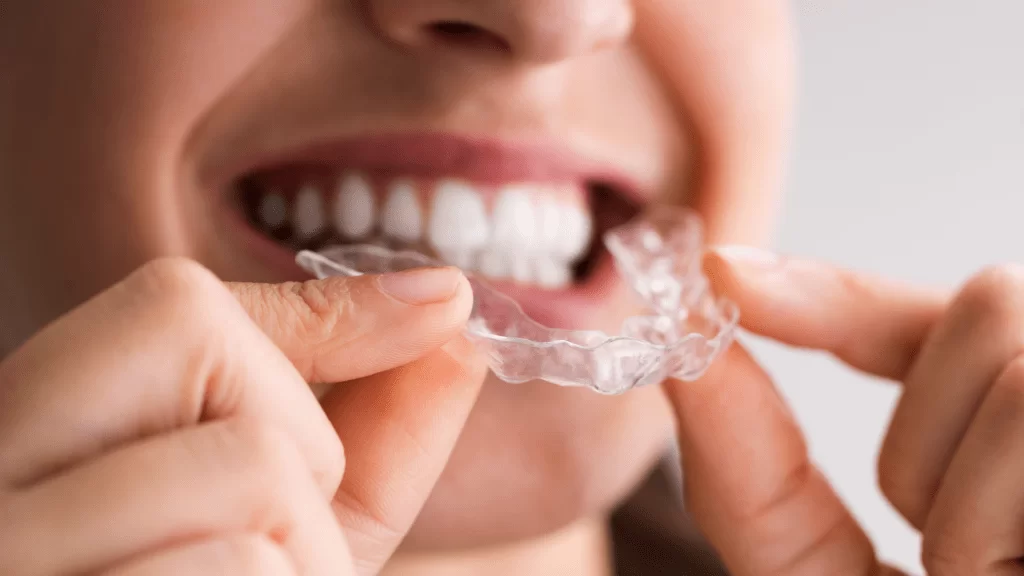 Discover your Perfect Smile with Clear aligners  