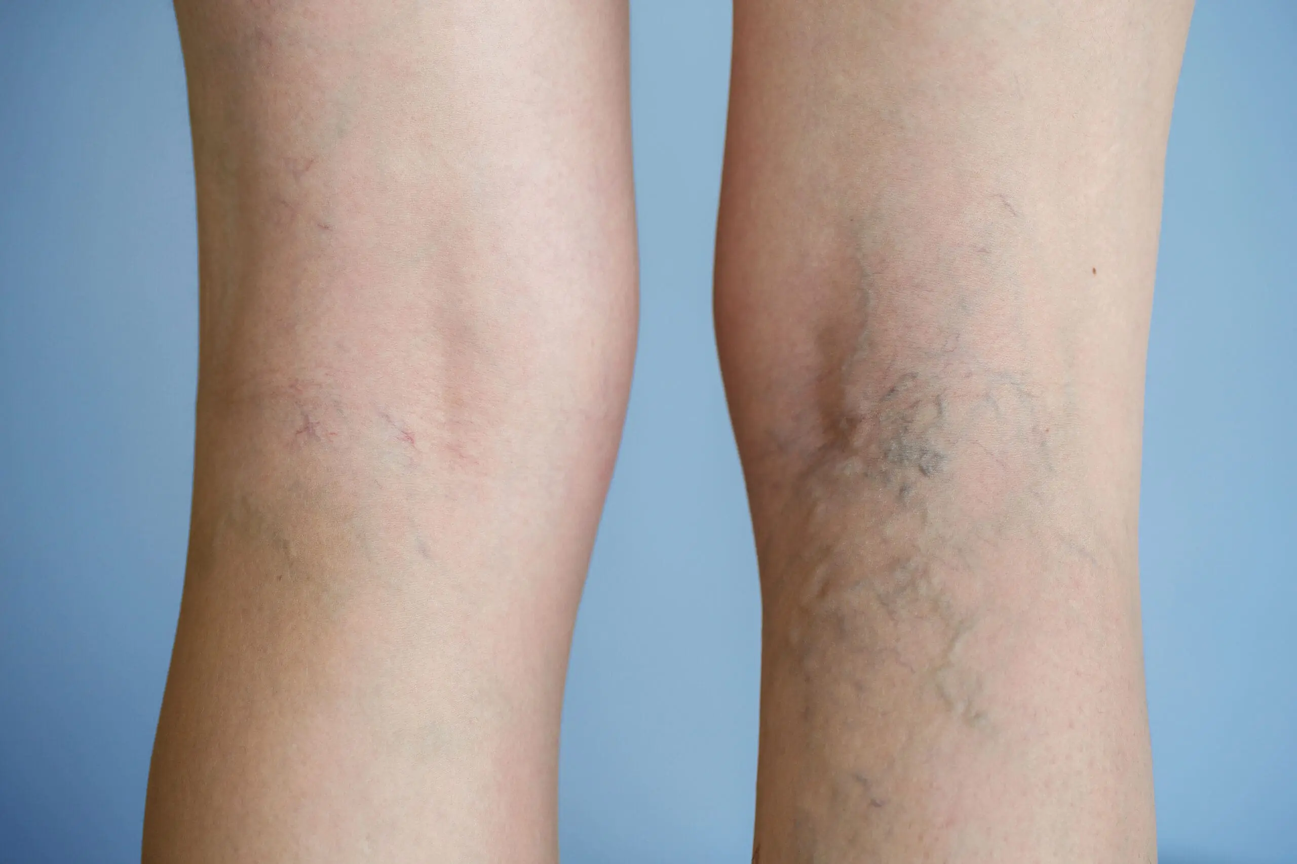 Why Do I Have Spider Veins if I’m Healthy?